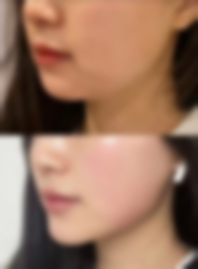 做完眼袋多久可以做双眼皮？核心区间2 - 6个月，具体需结合恢复及医生评估确定！ 