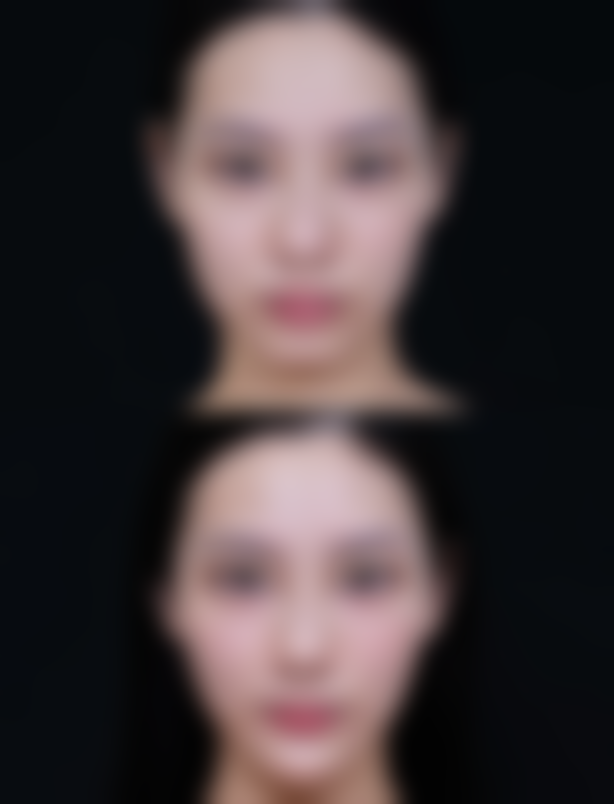 瘦脸针打完脸颊凹陷怎么办？常见原因及改善方法大揭秘，日常注意事项也别错过！ 