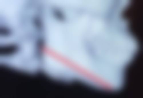 隆胸的假体破裂后及时就医评估