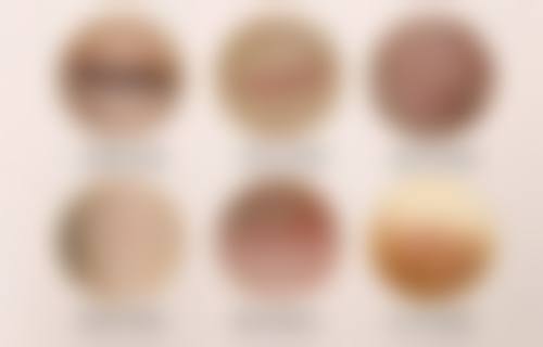 手术矫正：适用于较重度泪沟情况