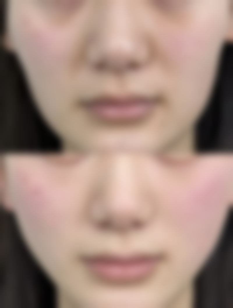 眼袋手术后用什么疤痕膏？硅酮凝胶、肝素钠尿囊素凝胶等可选，使用要点及注意事项揭秘！ 