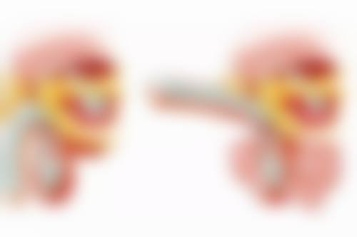 手术治疗去除疤痕疙瘩