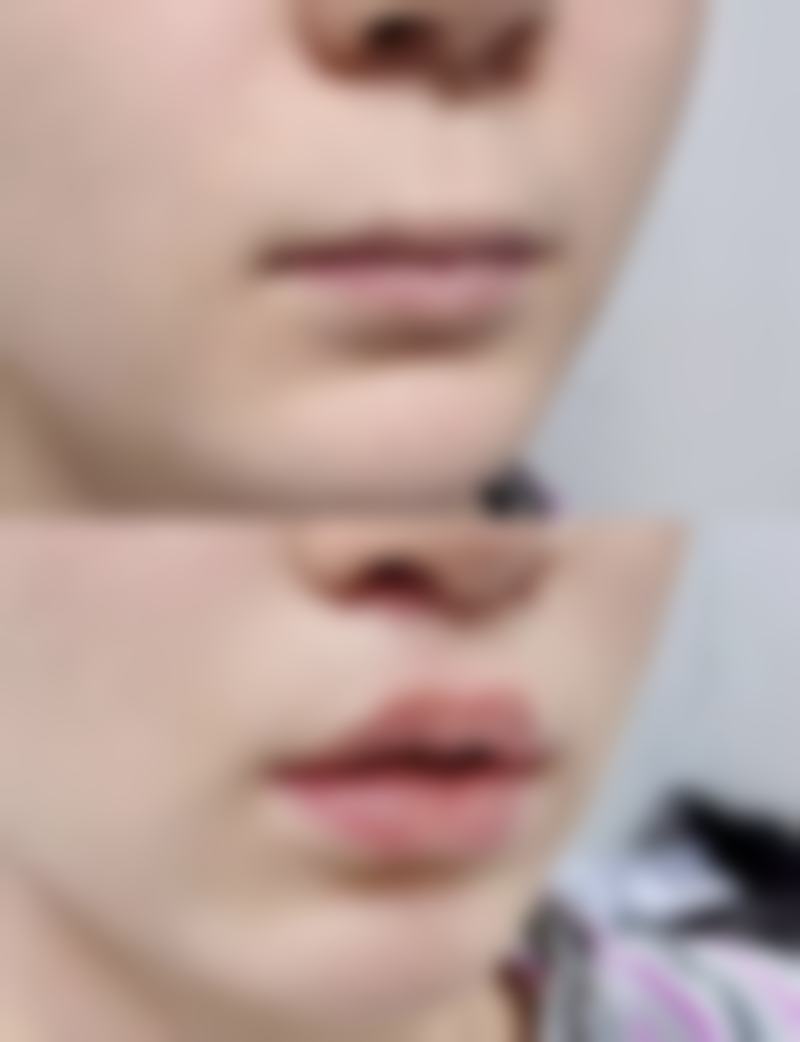 韩式三点双眼皮手术过程要多久