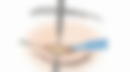 个人体质对割双眼皮修复时间的影响