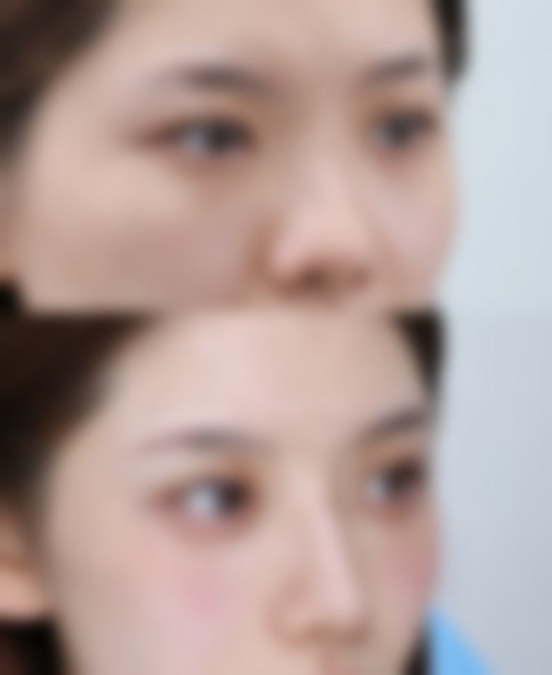 影响自体隆胸手感的材料因素