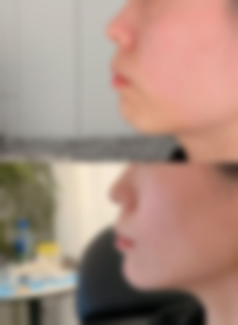 选择假体隆胸260的注意事项