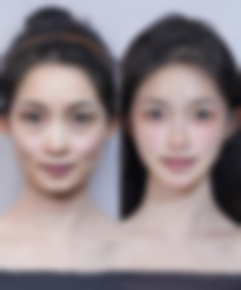 五、郑州至美医疗美容晁爱芝医生技术怎么样？