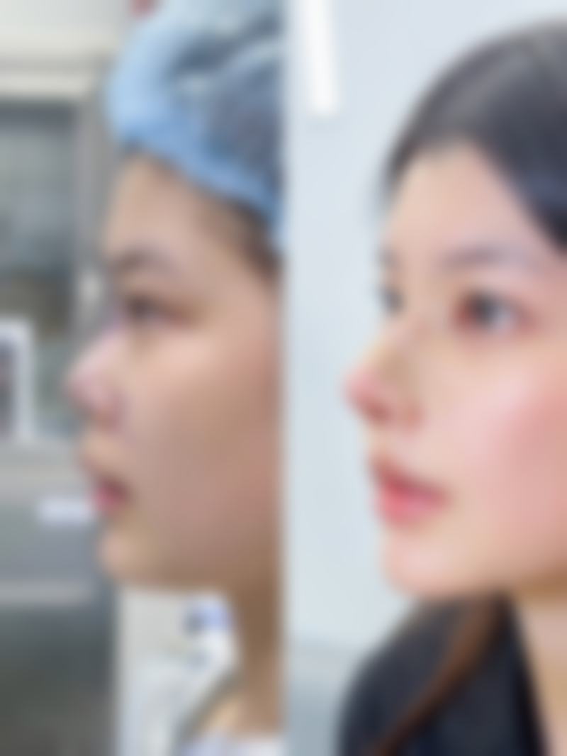影响激光去陈旧性疤痕成效的因素