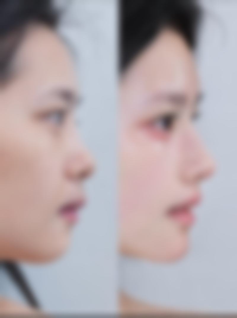 瘦脸针打完可以吃东西吗？答案是可以，但要注意时间和饮食原则，否则影响效果！ 