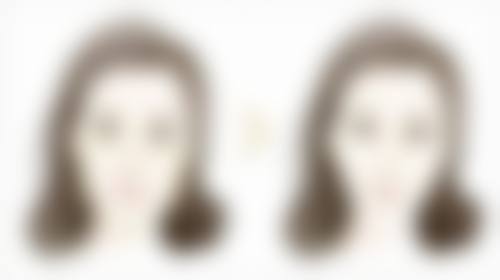 手术操作对三点定位双眼皮持久性的影响
