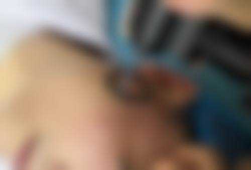肋软骨隆鼻适用的特定人群