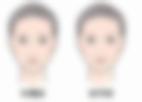 五、北京伊美尔郭海燕医生技术怎么样?