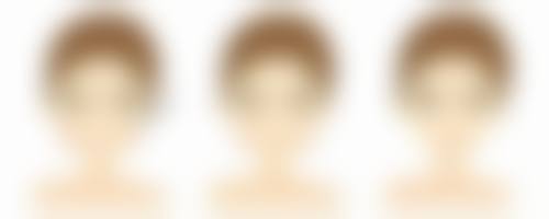提高眼袋手术疤痕修复成效的注意事项