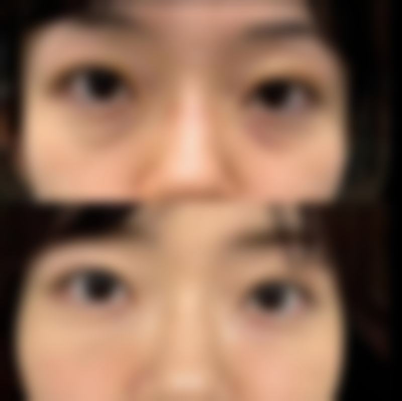 真性肉条的成因及特点