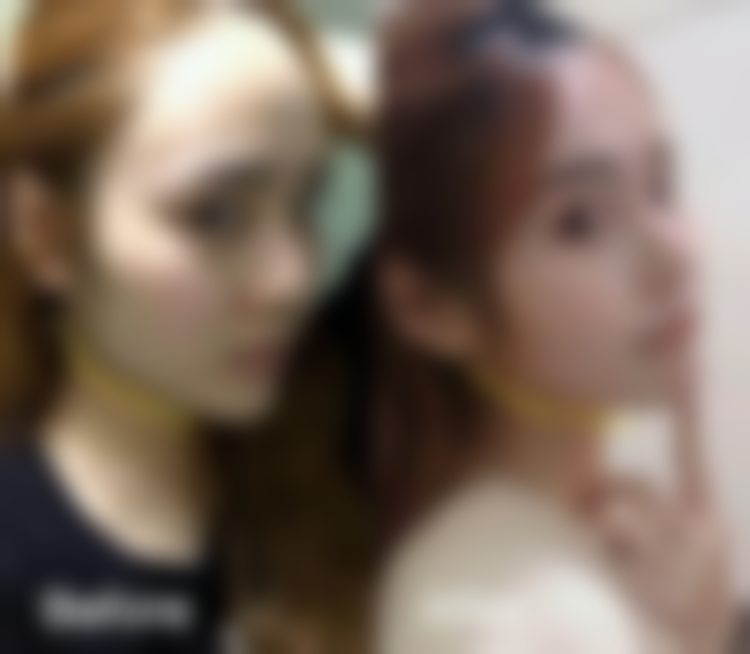 杭州连天美激光紧缩阴道项目的成效