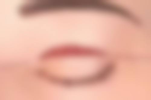 双眼皮修复单眼皮的成效和风险
