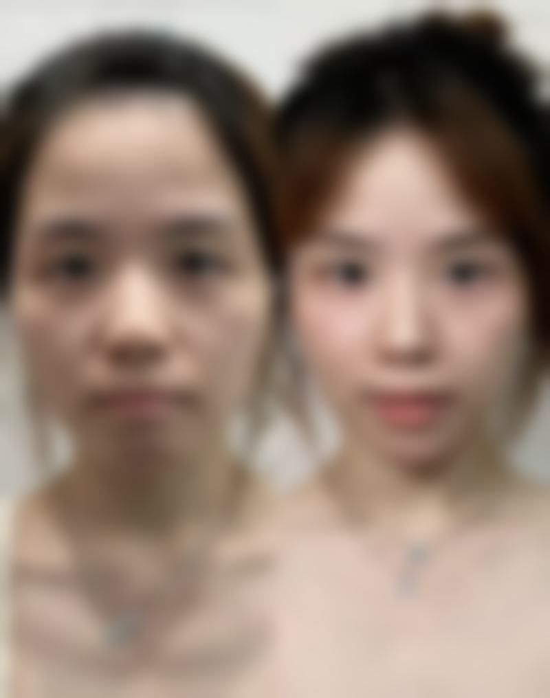 手臂吸脂完全恢复多久？受个体体质等多因素影响，一般3 - 6个月达最终稳定效果！ 
