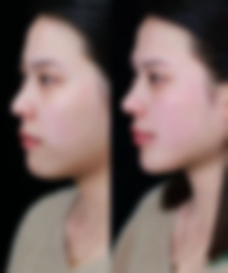 做内切眼袋会使眼睛凹陷吗？可能与过度去脂、泪沟情况等有关，部分人可逐渐恢复！ 