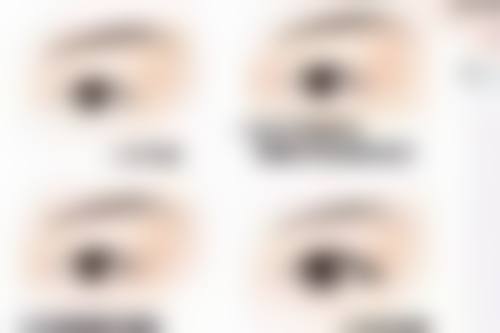 普通隆鼻中可吸收线的吸收时间