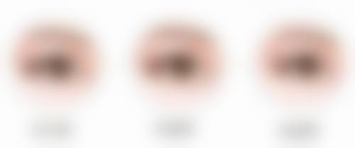 如何选择适合自己的双眼皮手术方式