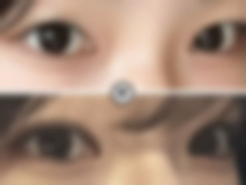 祛痣留下的凸起疤痕能去掉吗？情况不同结果有别，轻症或可祛，重症多是淡化改善！ 