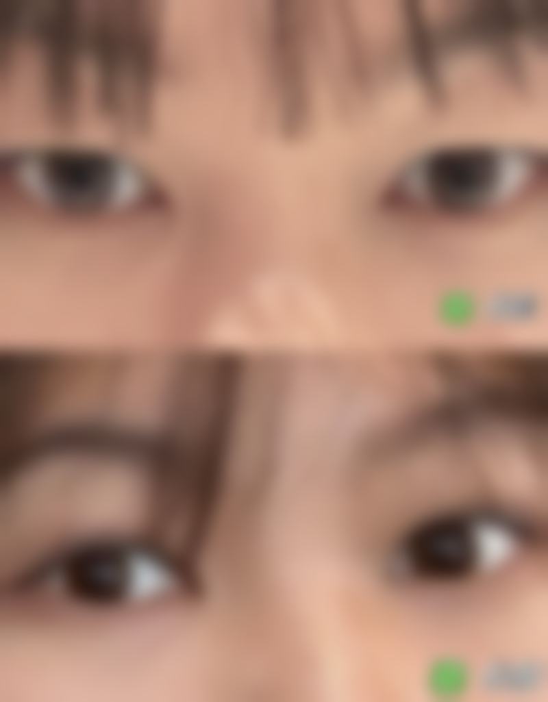 如何避免眼轮匝肌处理不当