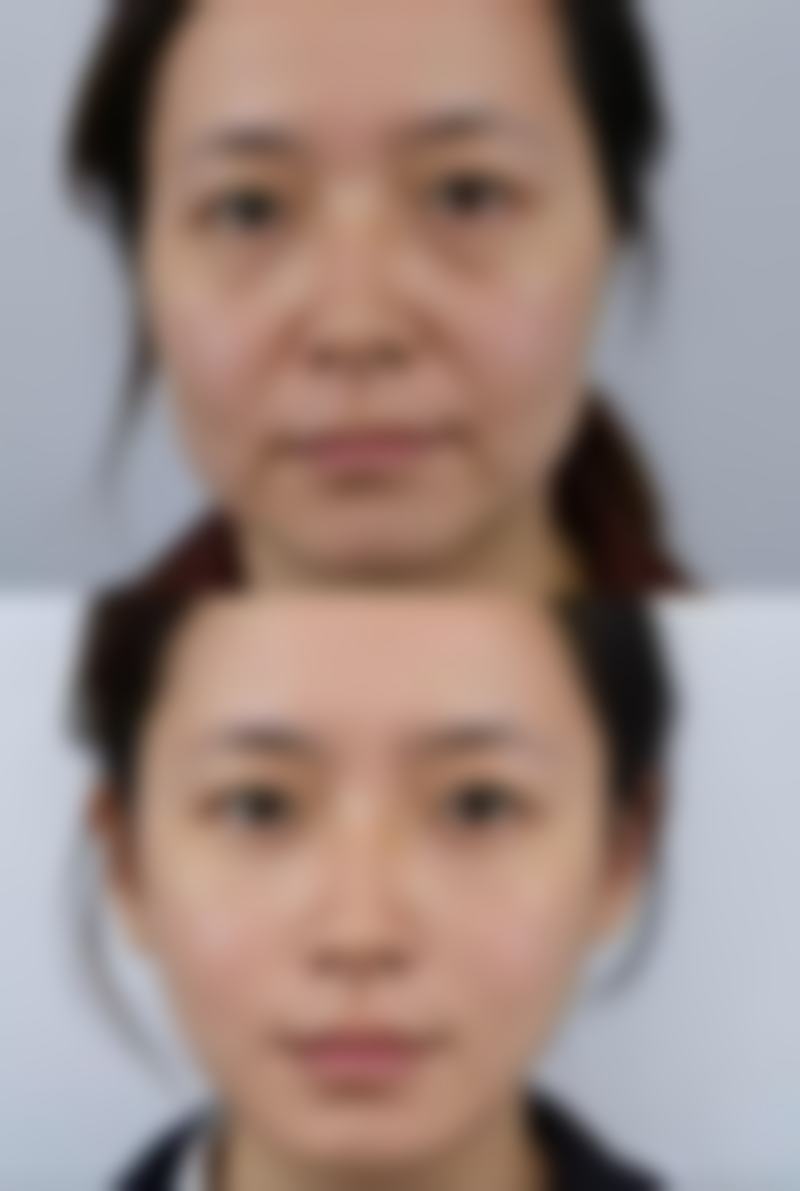 国产假体隆胸的局限