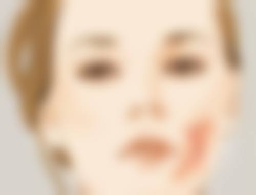 不同隆鼻术式的修复周期