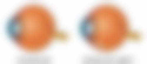 无痕全切法实现筋膜恒久无痕双眼皮