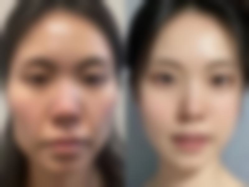 筋膜永久无痕双眼皮是怎样做的?常见有埋线、三点/五点定位微创、无痕全切法，操作各不同！ 