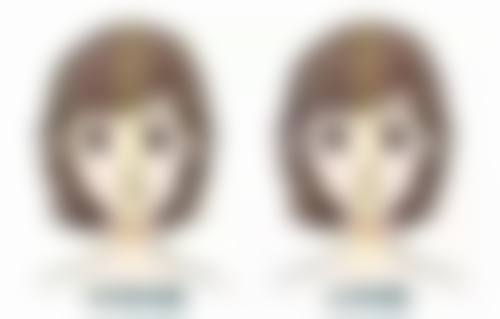 哪一种双眼皮比较好？不存在绝对最优，需结合眼部条件、审美偏好经专业评估后选择！ 