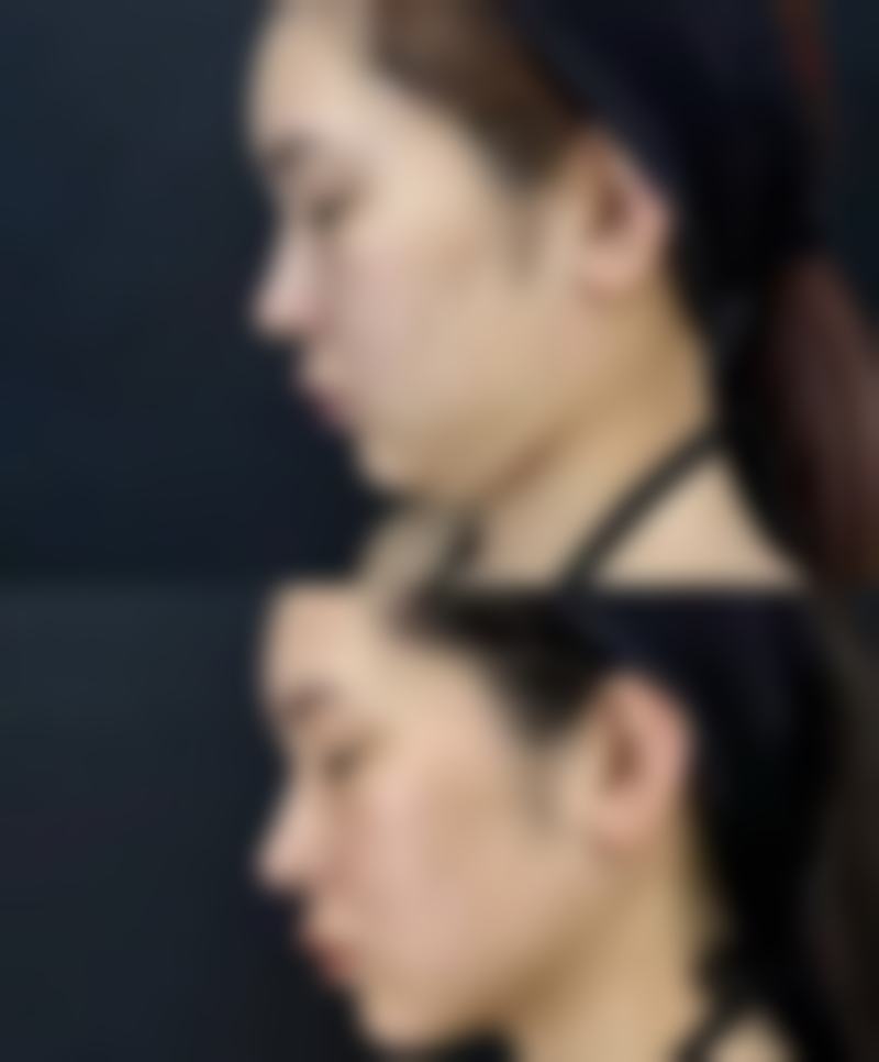 眼部条件对双眼皮选择的影响