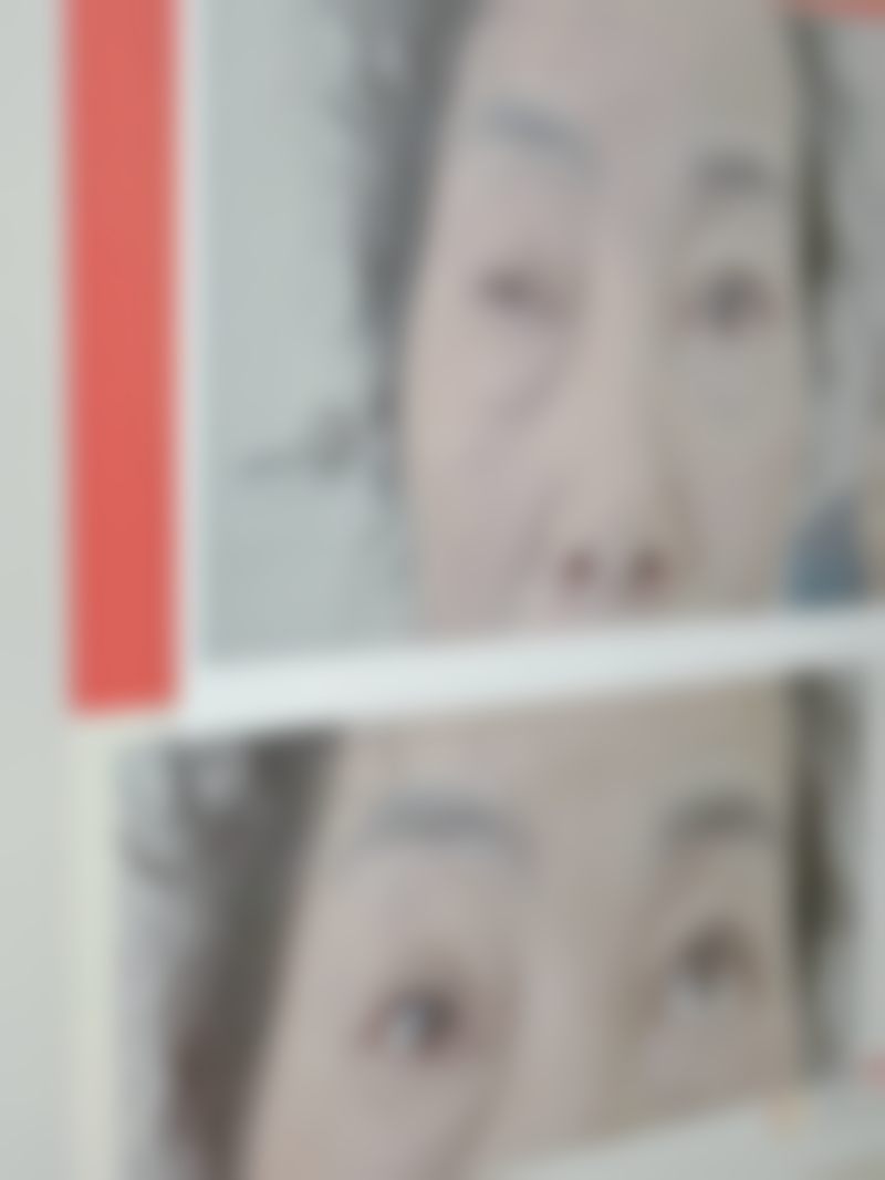 吸脂什么时候效果最好？普通抽脂1 - 6个月、面部吸脂3个月、下巴吸脂2个月左右效果佳！ 