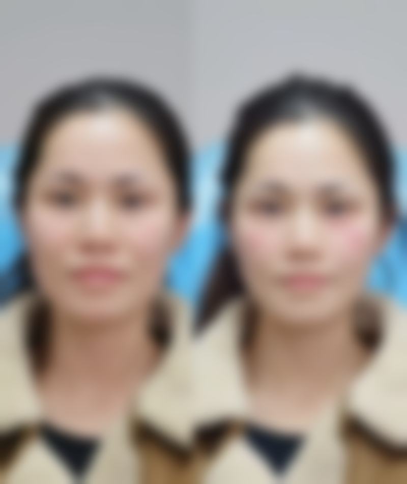 面部青春痘疤痕怎么治疗？可从一般护理、药物、物理、手术、填充等多方面入手，分型施治！ 