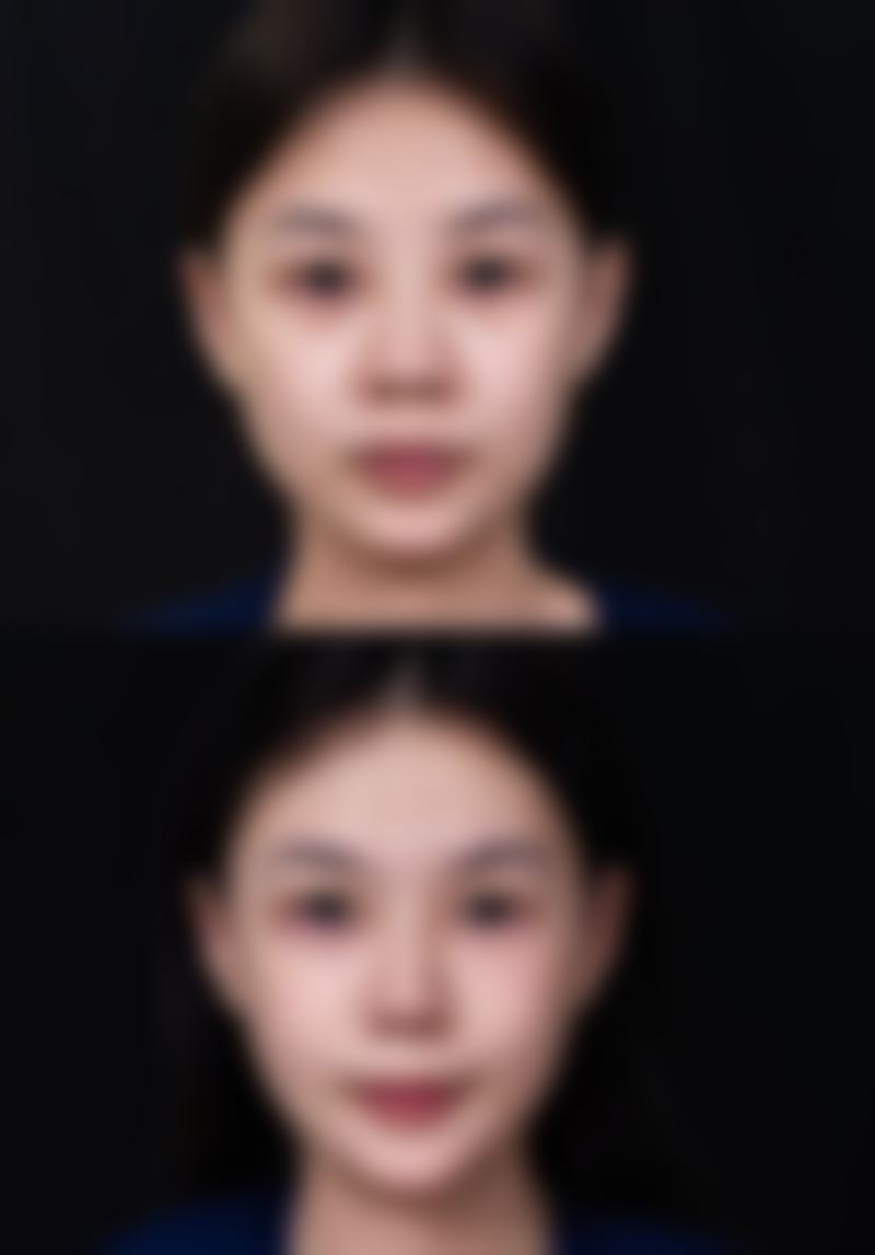 下巴吸脂成效至佳时间
