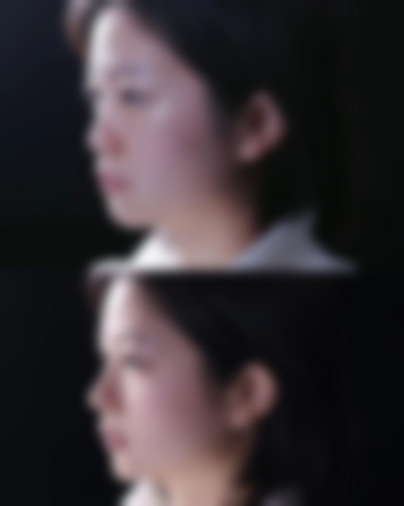 盐水假体:经济实惠的选择