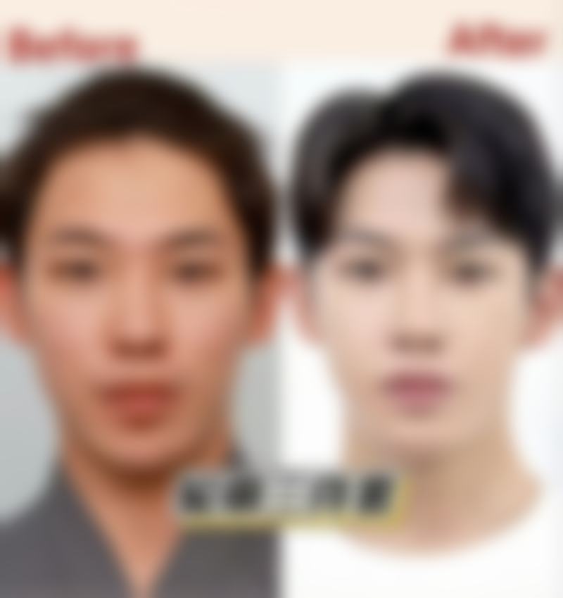 多数人1个月基本修复可适当泡温泉