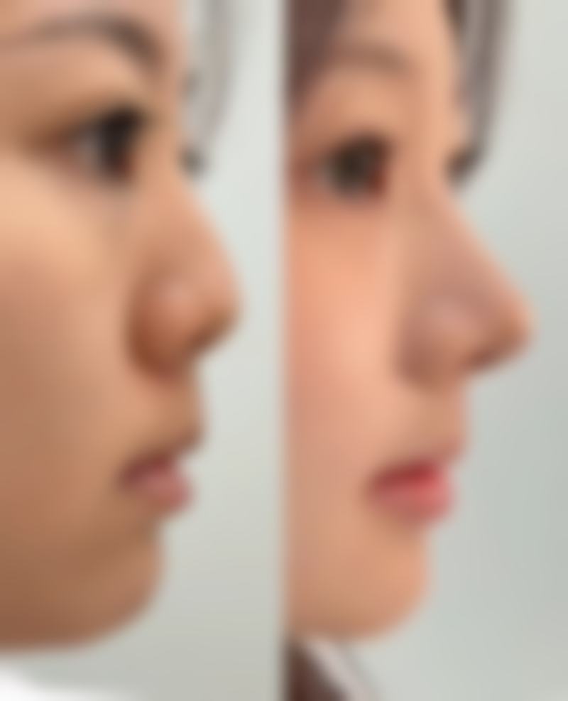 五、深圳天美医疗美容林芳佩医生技术怎么样？