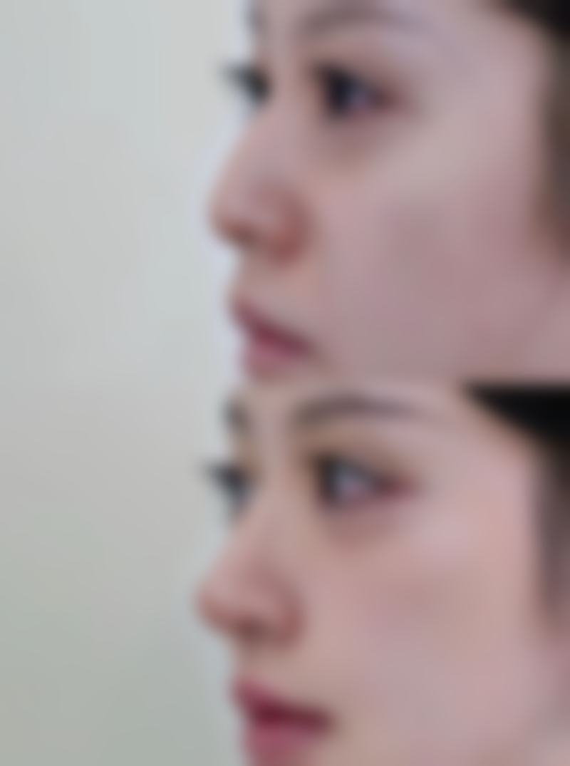 眼角单眼皮眼尾双眼皮型