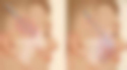 割双眼皮手术开眼角多长时间？联合手术1 - 2小时，还受医生、眼部情况等因素影响！ 