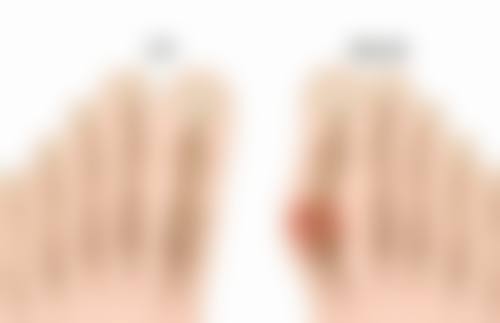 瘢痕异常造成的红色疤痕