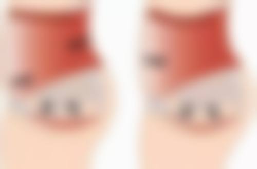 超声波祛眼袋的术后护理要点