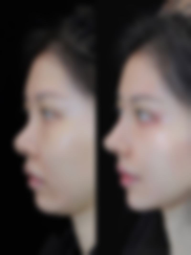 割了眼袋多久能恢复？恢复时间因手术方式而异，还受多因素影响，术后护理也关键！ 