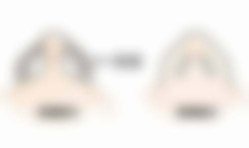 玻尿酸可以擦眼袋吗？外用玻尿酸难除眼袋，但能保湿润眼，缓解干燥疲劳！ 
