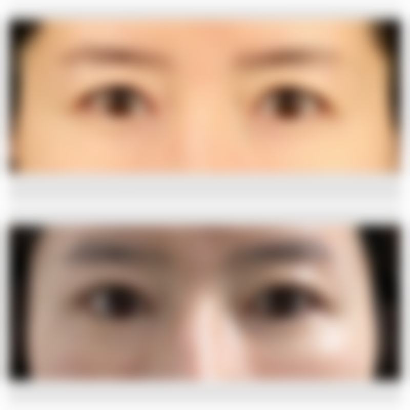 三岁宝宝的缝针疤痕多久可以激光治疗?主流建议拆线后1月 - 12月，3 - 6月较适宜！ 